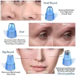 Aspirateur Électrique de Points Noirs DermaSuction – Extraction Douce – Image 2