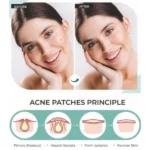 patchs anti-acné boutons hydrocolloïdes hypoallergéniques pour le visage hanel 72 pcs