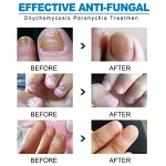 nail fungus crème antifongique anti-mycose réparatrice pour ongles