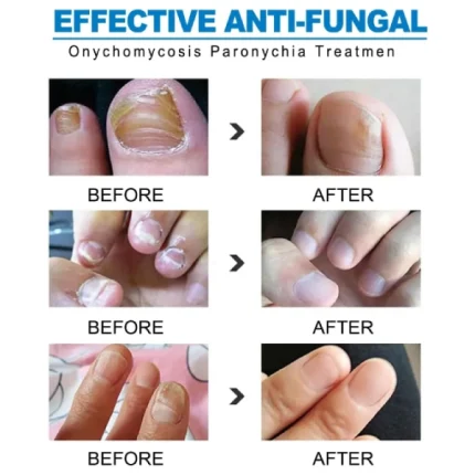nail fungus crème antifongique anti-mycose réparatrice pour ongles