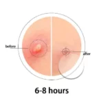 patchs anti-boutons hydrocolloïdes invisibles pimple patches anti-acné